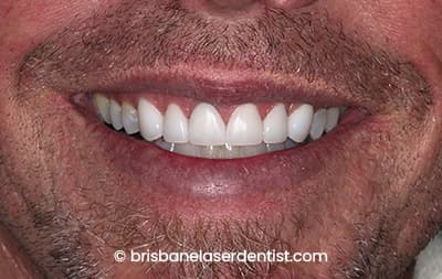 After veneers