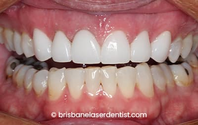 After veneers