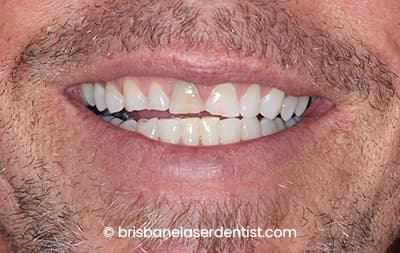 After clear aligners