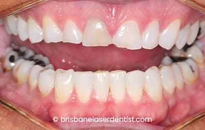 After clear aligners