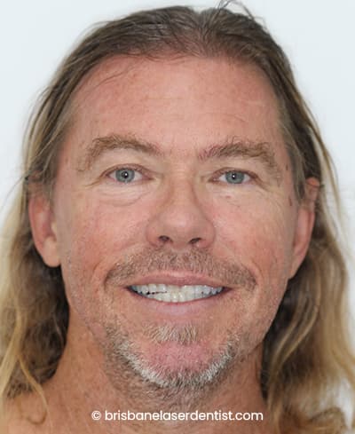 After clear aligners